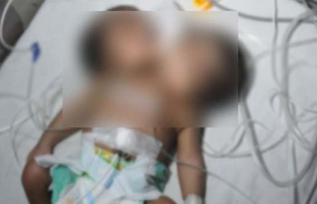 بھارت، 2 سروں والے بچے کی پیدائش پر والدین اسپتال سے فرار
