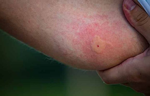 Tips to avoid summer mosquitoes