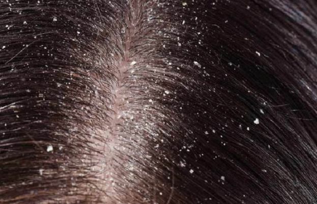 How to Get Rid of Dandruff